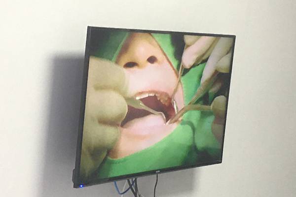 哪些情况需要补牙？