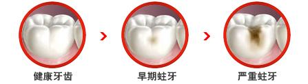 蛀牙牙龈疼痛怎么办？