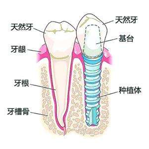 合肥种植牙价格表