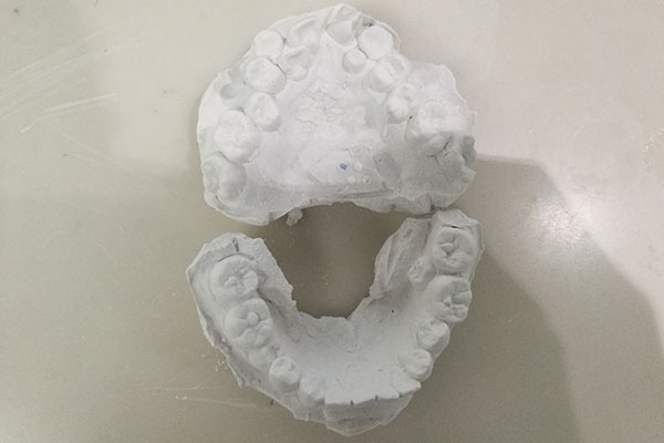 合肥牙科种植牙多少钱？
