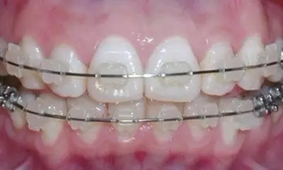 成年人牙齿矫正方法有哪些？