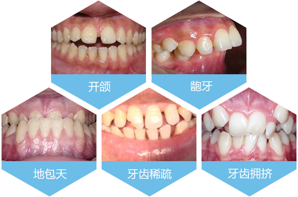 牙齿畸形的种类